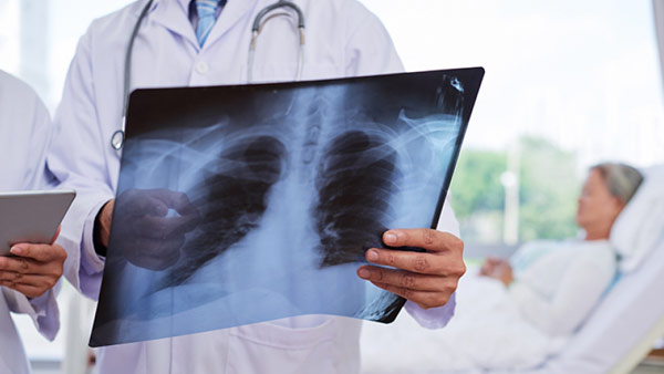 Plano de saúde nega medicamento Ofev para paciente com fibrose pulmonar idiopática