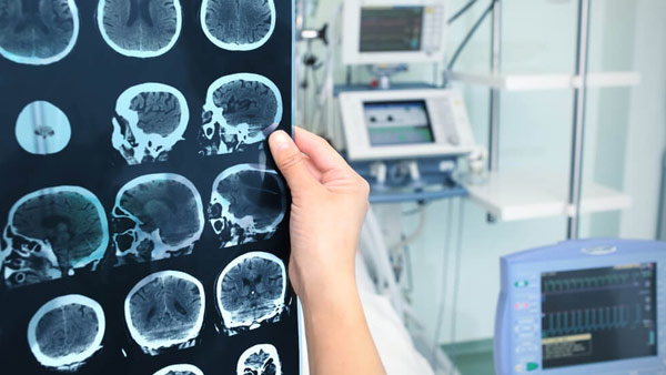 Eletroencefalograma: Plano de saúde deve custear despesas com exame 