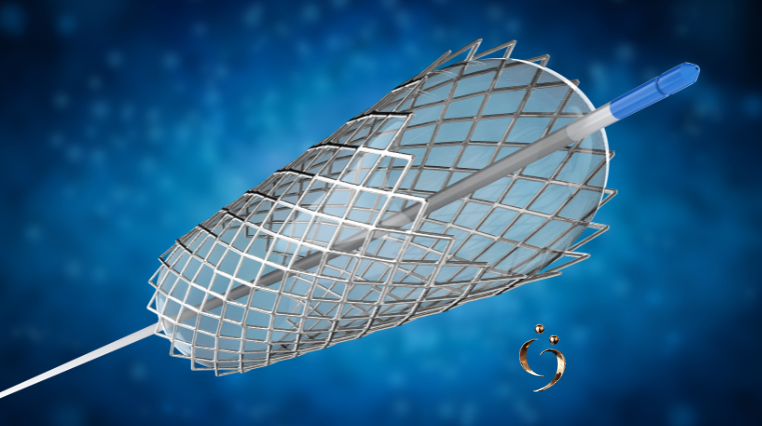 Foto Planos de saúde devem cobrir implante de duplo stent